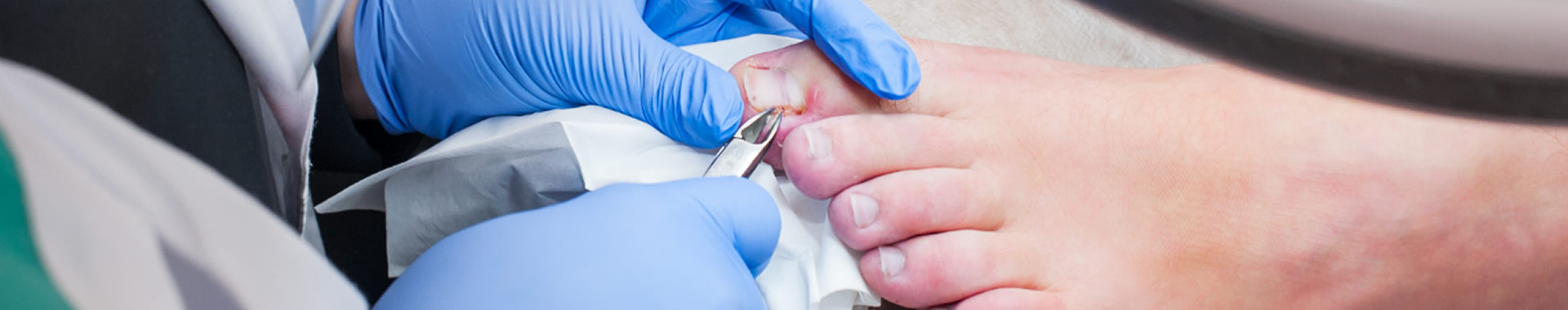 Ingrown Toenail Surgery (PNA) | East Gosford Podiatry