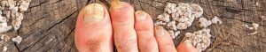 fungal nail infection