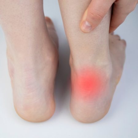 achilles tendonitis