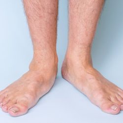 Flat-foot-2
